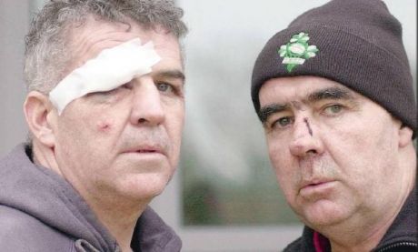 Click on image to see full-sized version Injuries dished out by Gardai to Pat O'Donnell and his brother Martin